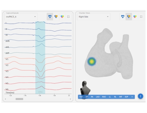 CORRECTING and REPLACING Heart Rhythm Case Reports Publishes Notable Case Detailing First Use of AI-Guided ECG Mapping for Left Bundle Branch Area Pacing