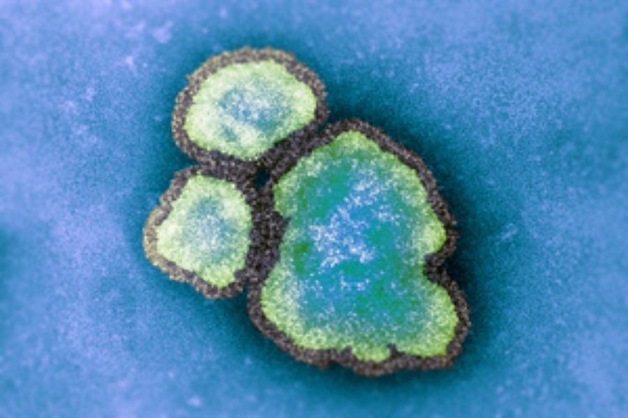 Alberta's measles case counts have topped 500 and doctors are worried