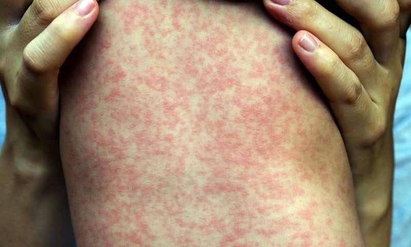 2 cases of measles confirmed in P.E.I., with many public exposure sites listed