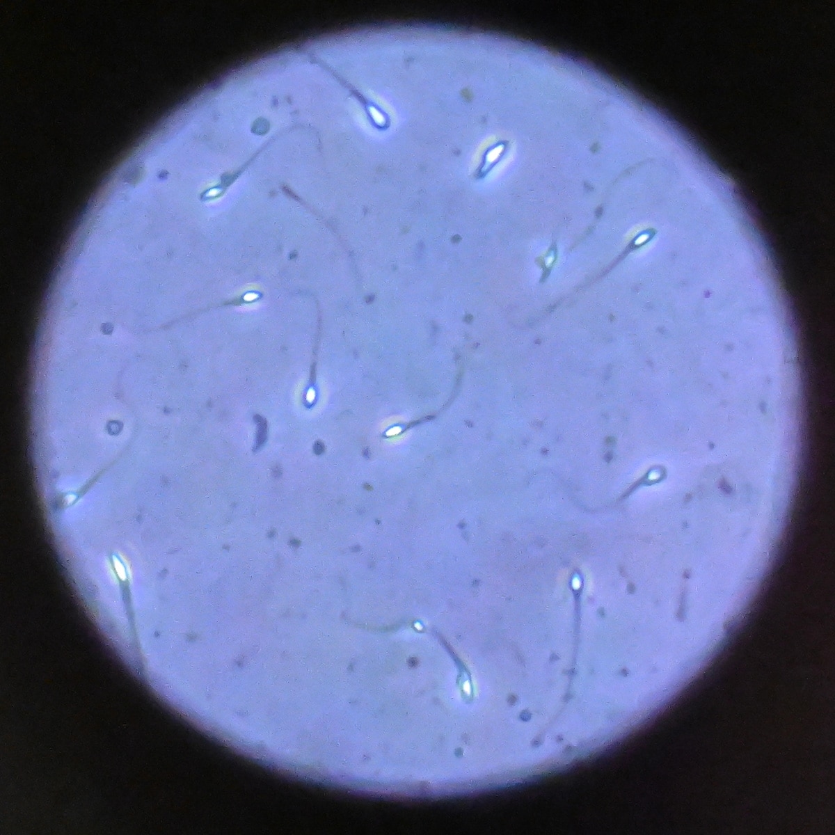 Sperm Donor With Rare Mutation Linked to Cancer Sparks Debate