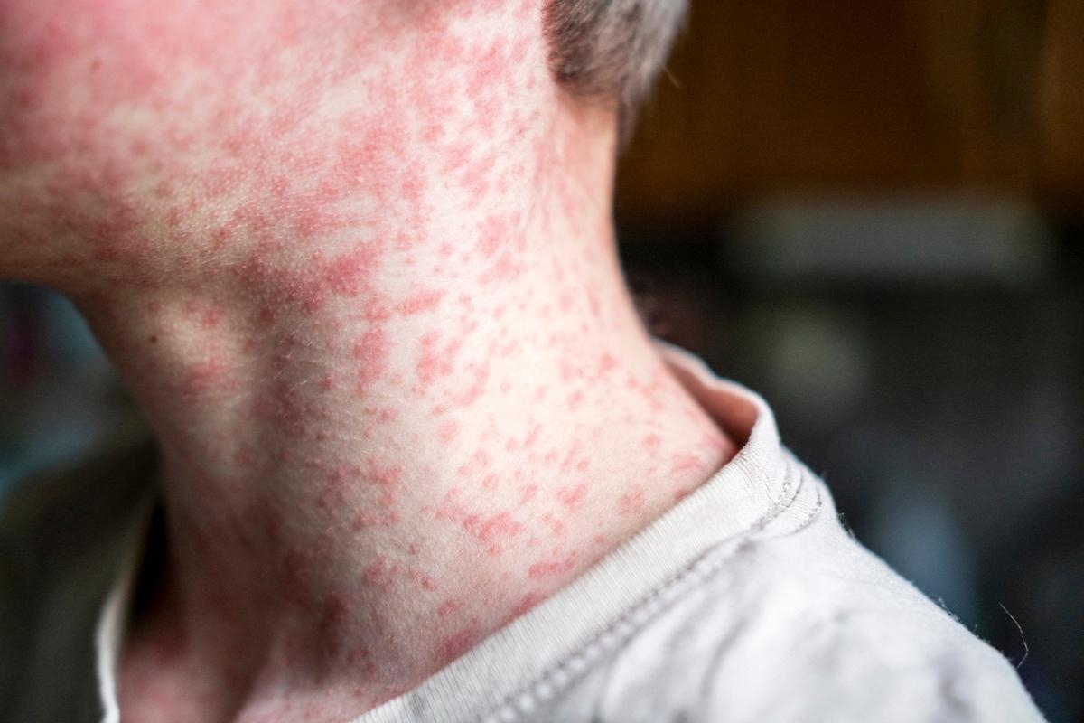 What to do if you have measles - symptoms and when to call for a doctor or 999