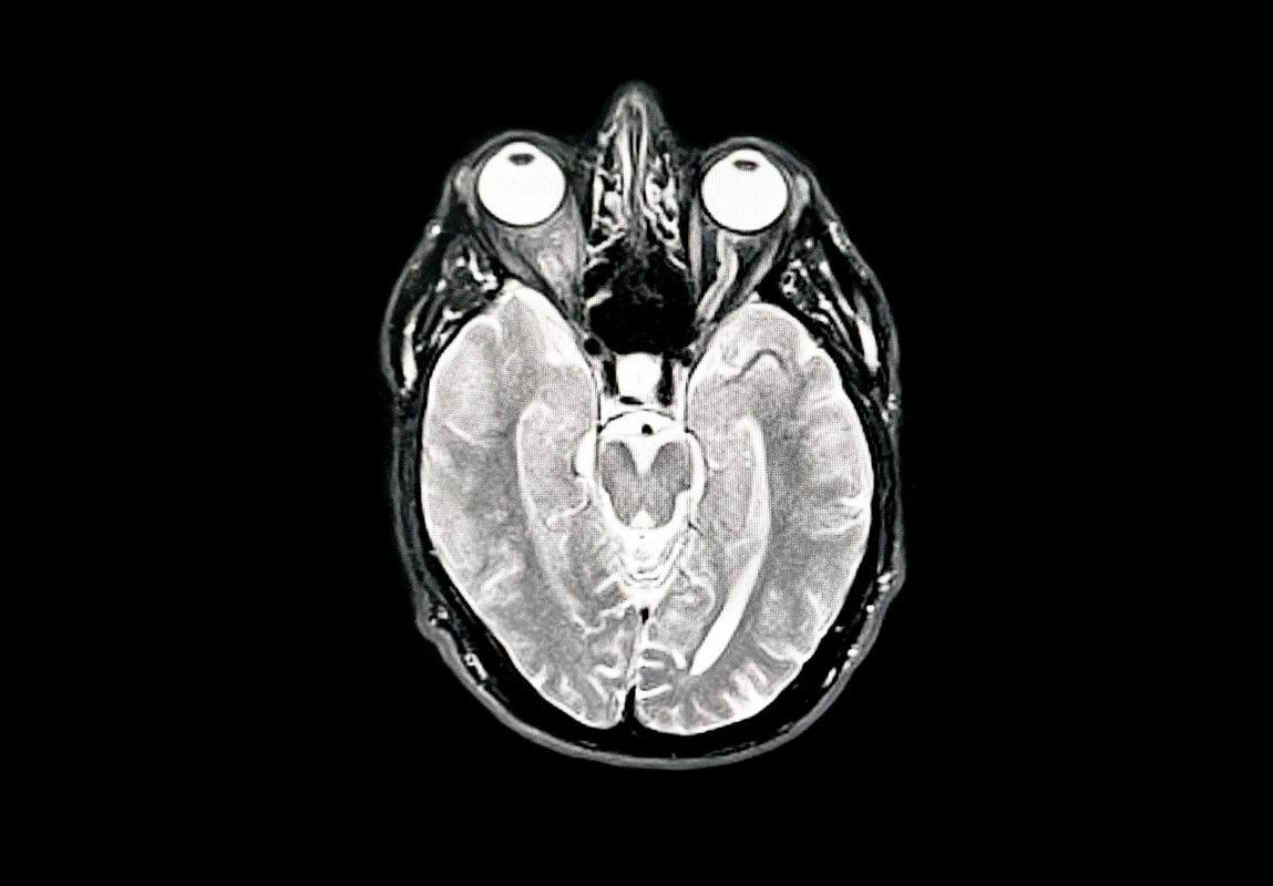 Surprise Discovery Could Rewrite What We Know About Alzheimer's
