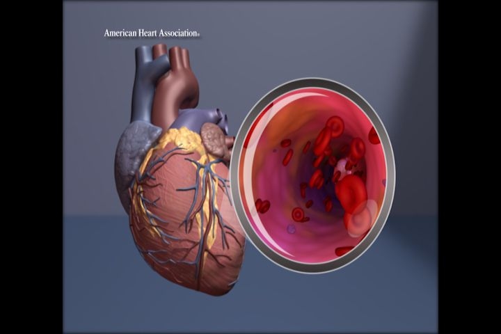 Still top cause of death, the types of heart disease people are dying from is changing