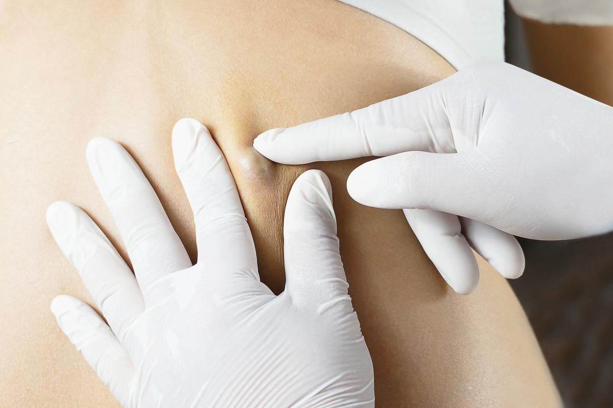 Dermatologist Reacts to 'Super Juicy' and Satisfying Cyst-Popping Video