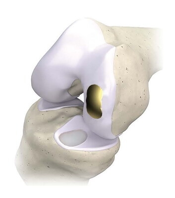 Overture Orthopaedics Announces Full Commercial Launch of the OvertureTi Knee Resurfacing System® to Treat Early Osteoarthritis and Cartilage Defects