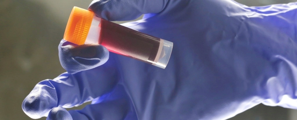 Your Blood Type Affects Your Risk of an Early Stroke, Study Finds