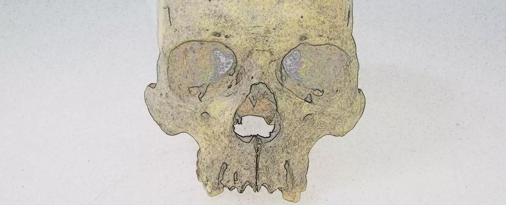 Mysterious Leprosy Pathogen Has Lurked in The Americas For 4,000 Years