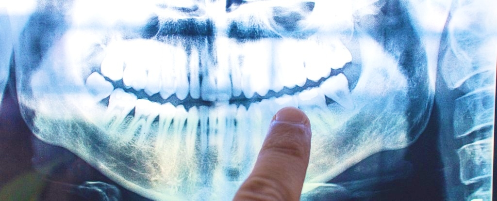 The Cause of Alzheimer's Might Be Coming From Within Your Mouth
