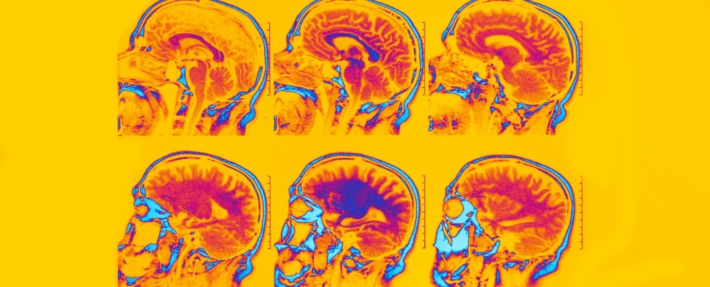 Huge Study Reveals 2 Vaccines That Appear to Reduce Dementia Risk