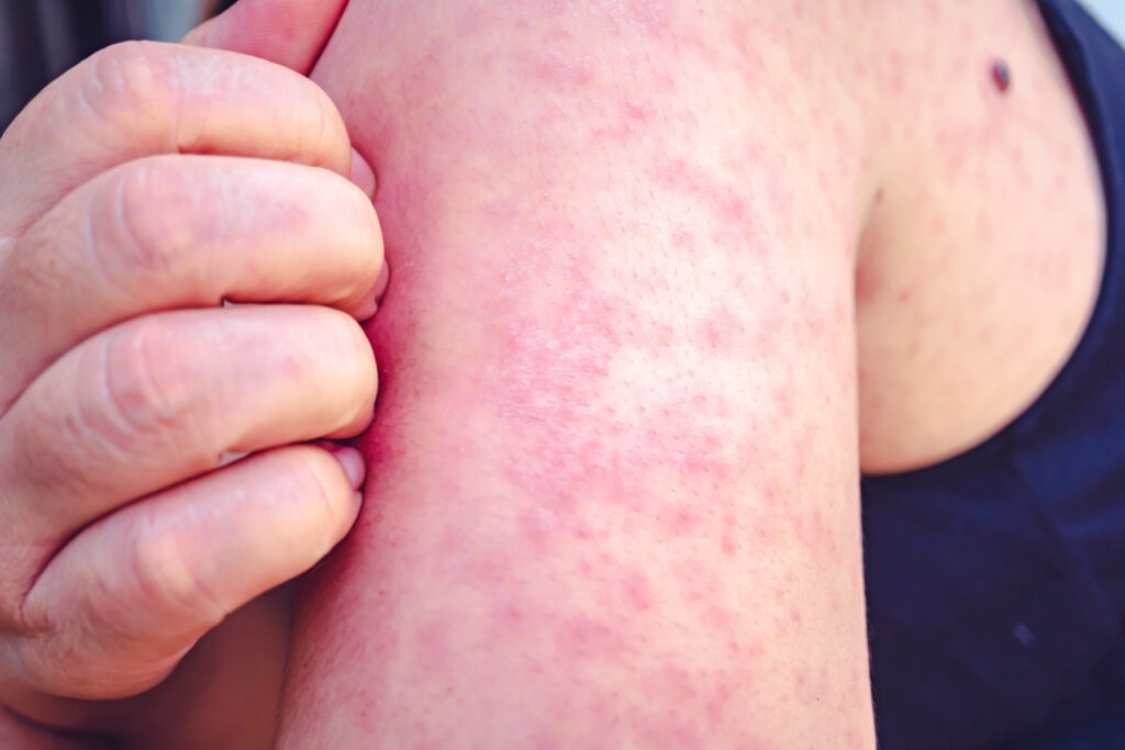 Possible measles exposures at Sunport; other locations from traveler cases