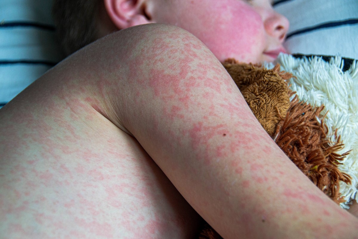 Two London boroughs record among highest measles cases in UK