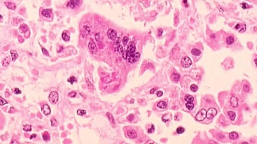 Local hospital visitors may have been exposed to measles