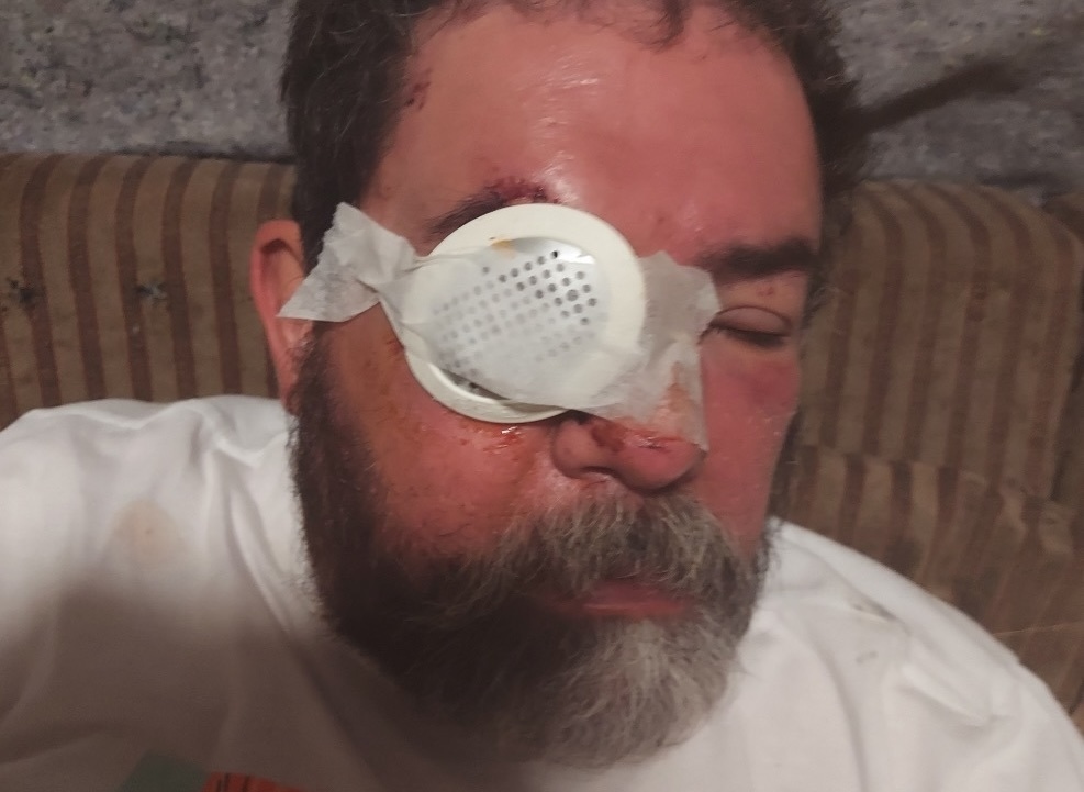 Homeless San Francisco man blinded in fireworks accident, family launches fundraiser