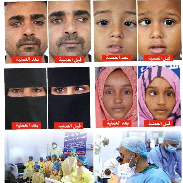 انطلاق المخيم الطبي المجاني الثاني لجراحة حَوَل العين في المخا غدًا