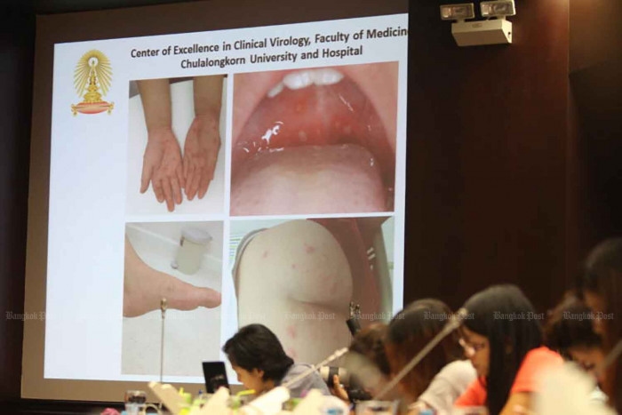 Govt confirms hand, foot and mouth disease outbreak