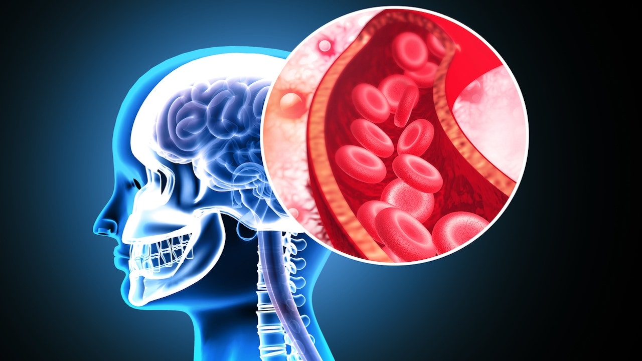 Stanford researchers develop ‘game-changing' stroke treatment that doubles effectiveness
