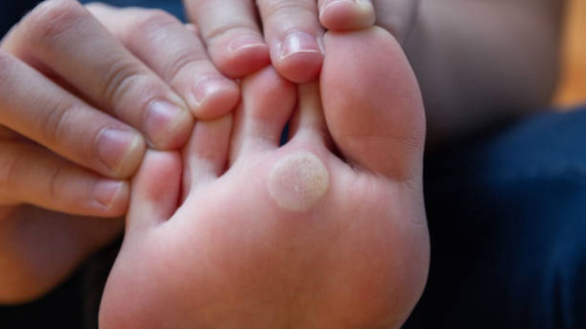 Warts or corns? A quick guide to these common foot problems