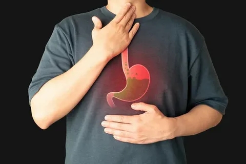 Top 7 questions about anti-reflux surgery?