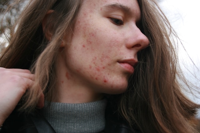 7 Natural Remedies for Acne-Prone Skin