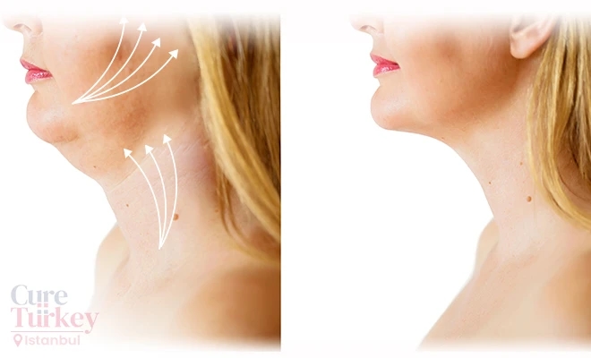 Tips to Achieve the Best Results Through a Chin Liposuction in Istanbul