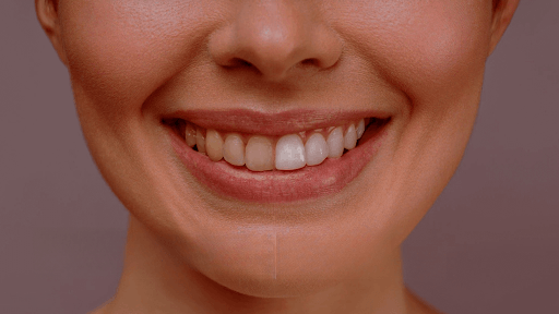Ceramic Veneers vs. Porcelain Veneers: Which One Is Better?