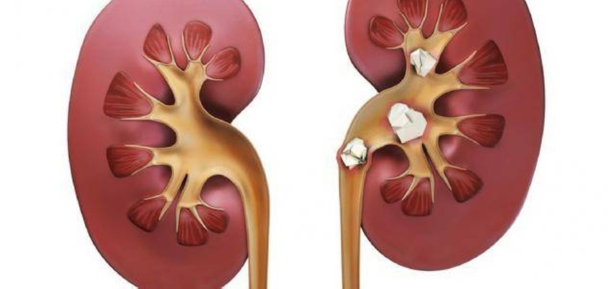 أطعمة شائعة تسبب حصوات الكلى