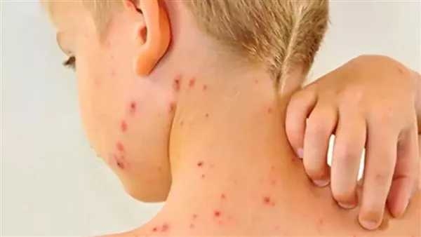 : تواجه الولايات المتحدة أسوأ تفش للحصبة منذ أكثر من 30 عامًا