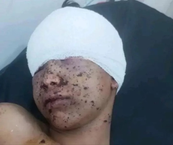 طفل يفقد إحدى عينيه جراء قصف حوثي استهدف حياً سكنياً شمال تعز
