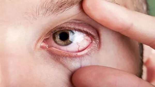 راقب عينيك.. 5 أعراض غير عادية تكشف ارتفاع الكوليسترول