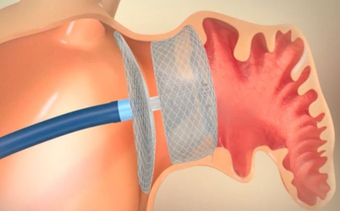 Mon Medical Center participates in trial for device that could revolutionize Afib treatment