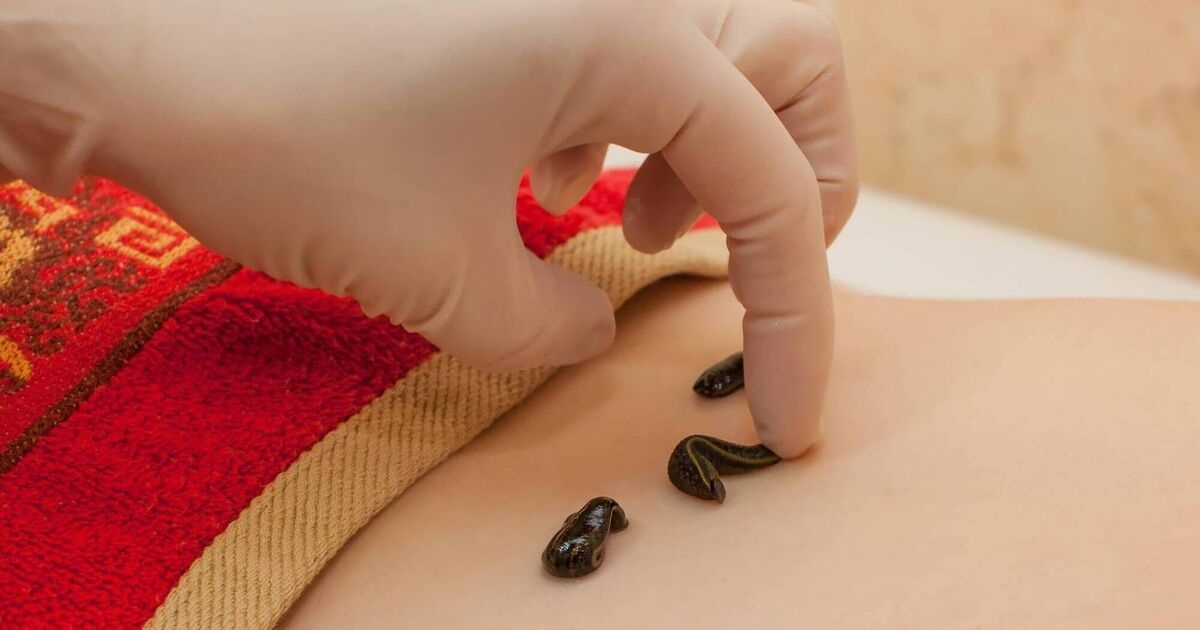 Richard Collins: Leeches suck — which can be handy at times