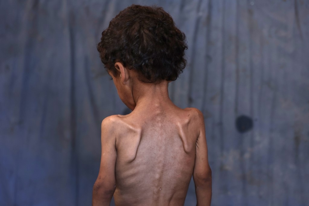At least 115 Palestinians have died from hunger and malnutrition: Report