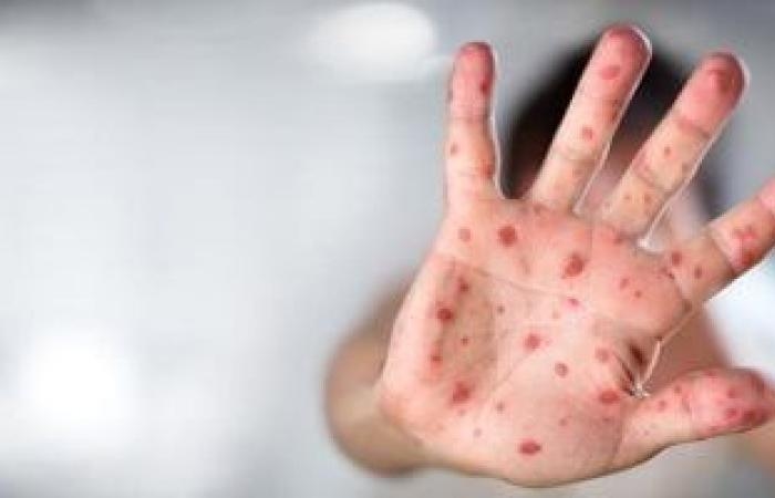 صحة وطب : بثور حمراء وحرارة.. طرق التعامل الأمثل مع فيروس كوكاساكى الذى يصيب الأطفال