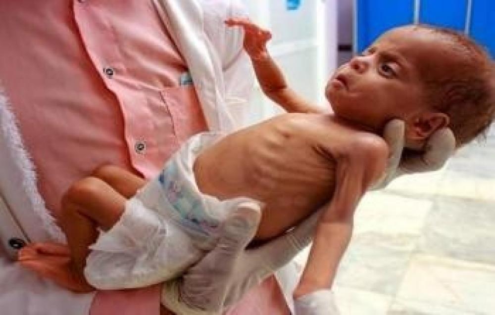 Palestinian Child Dies from Malnutrition in Gaza