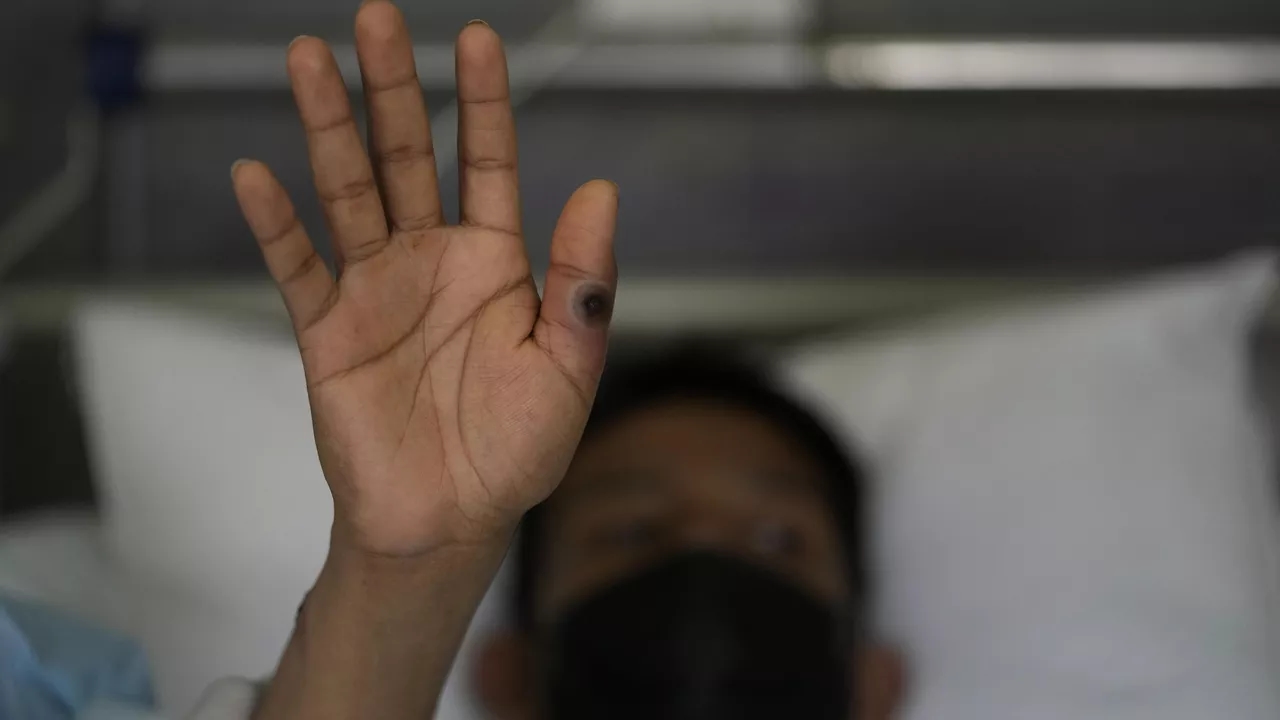 Financial Times: 12 African countries struggle to contain monkeypox outbreak