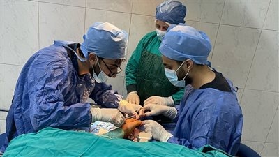 مركز الحروق بمستشفى ههيا ينجح في إجراء جراحة دقيقة لإنقاذ يد تعرضت لقطع بالأوتار والأنسجة