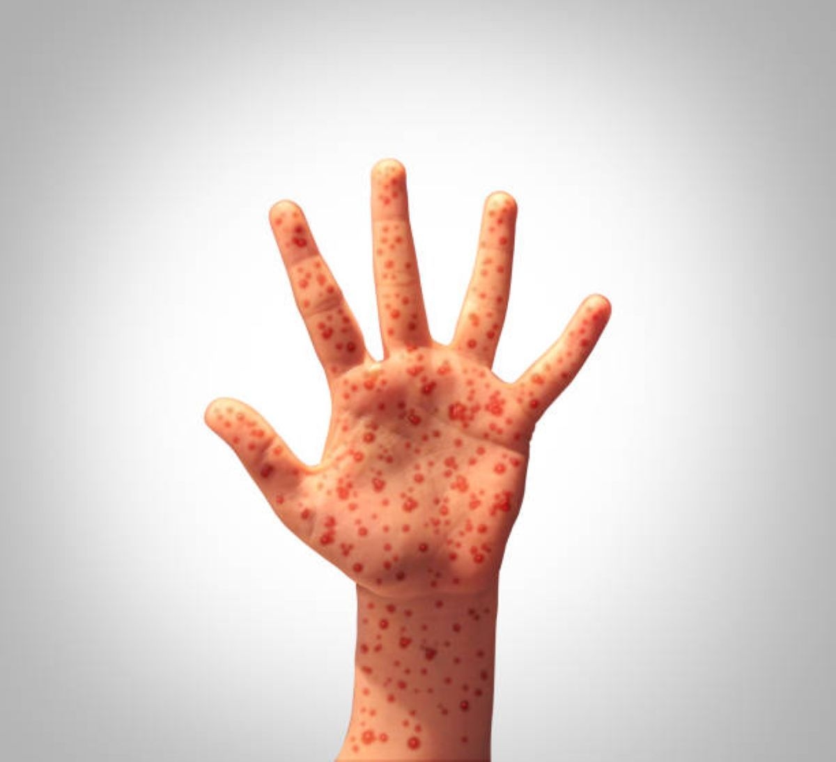 Measles outbreak confirmed in this province