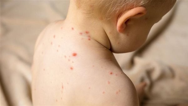 حمو النيل لدى الأطفال، أسبابه وطرق علاجه والوقاية منه